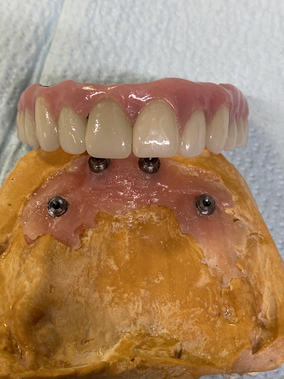 All-on-4 individual zirconia crowns on anodized titanium bar