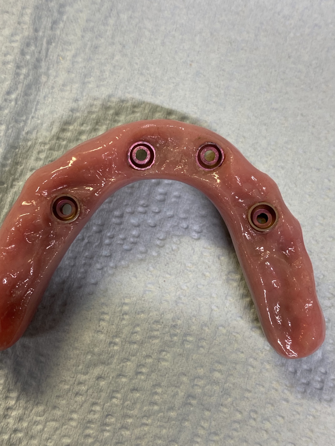 All-on-4 prosthesis intaglio view showing implant interfaces