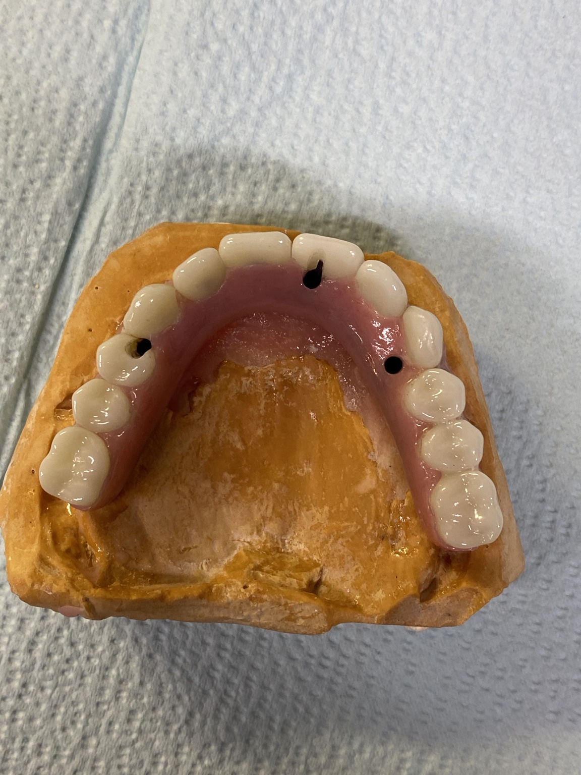Occlusal view showing access openings for All-on-4 delivery