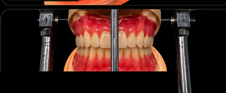 Ivocap Injected Complete Upper and Lower Dentures