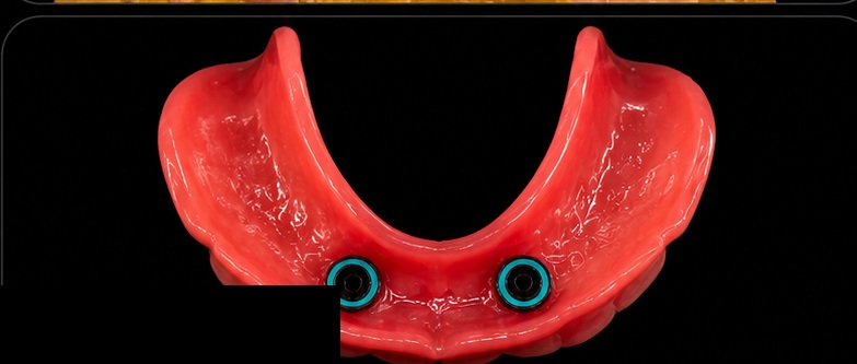 Locator overdenture