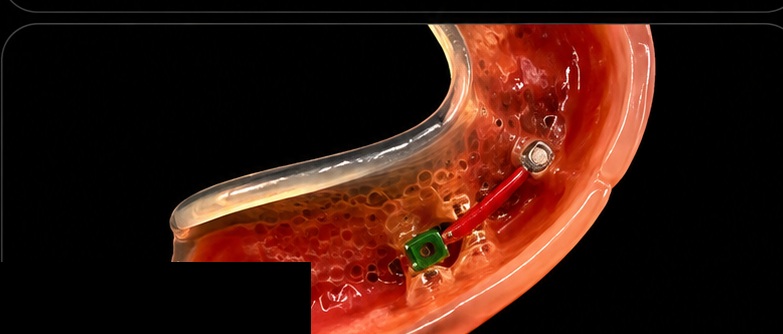 Reinforced prosthesis