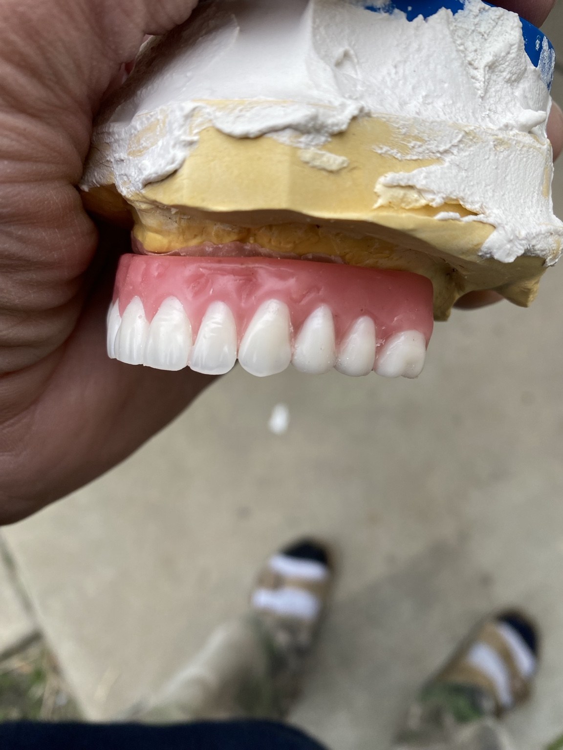 Implant-supported prosthesis fabricated by Advanced Dental Technologies